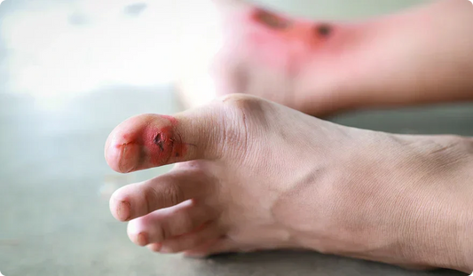 How to Prevent and Treat Pressure Sores at Home: A Step-by-Step Guide
