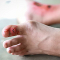 How to Prevent and Treat Pressure Sores at Home: A Step-by-Step Guide